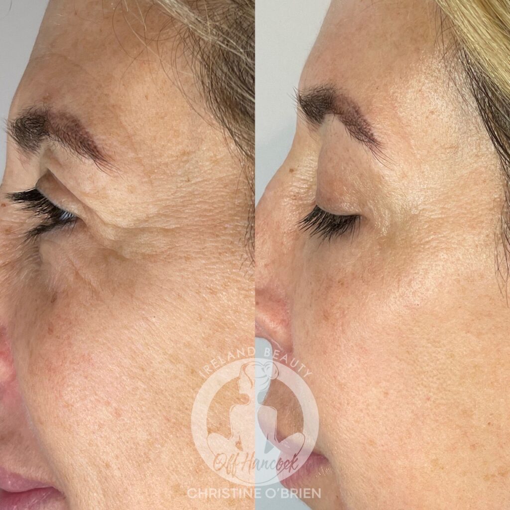 Before and after results of Plasma Skin Tightening.